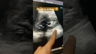 Stone in kidney shown in abdominal ultrasound #kidney #kidneystone #ultrasound #doctor #abdomen