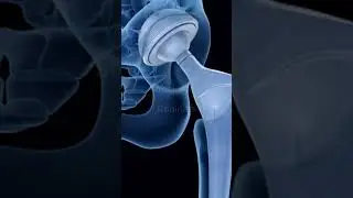 Effective Bone Cancer Treatments | Types & Latest Advances #top  #trending