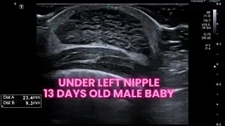 Ultrasound Male baby swollen nipples I breast enlargement