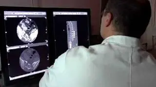 Removing Spinal Tumors: Dr. Rick Placide Describes the Benefits of Removing Cancer Spine Tumors