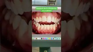 Alineadores invisibles, caso complejo con Invisalign