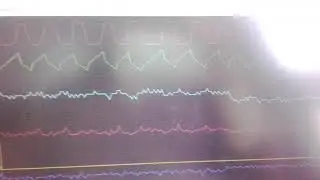 Testing AU falcon fairmont with forscan  checking general health of engine found problem with ripple