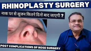 Rhinoplasty सर्जरी के बाद नाक पर से सूजन कितने दिनो बाद जाएगी ? | post complications of nose surgery