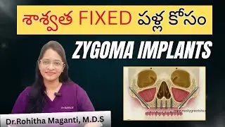 Zygomatic Implants for fixed teeth | Zygomatic Impants Indictaions & Procedure | Dr.M.Rohitha |