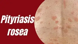 Pityriasis rosea | Causes | Symptoms | Treatments | Severe cases