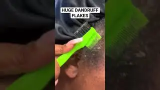 Dandruff scratching ASMR flakes scalp picking psoriasis scratch scales #dandruff #flakes