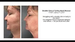 CRYO Therapy at Sirius Day Spa, Salon & Med Spa