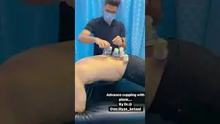 Advanced cupping with plank For Low Back Pain #chiropractor #spine #shorts