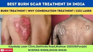 Best Burn Scar Treatment In India | Burn Treatment | Why Combination Treatment | CO2 Laser