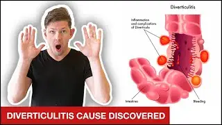 The ULTIMATE Diverticulitis Treatment Plan | 4 Simple Steps