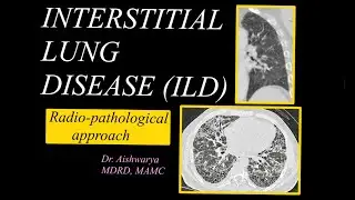 INTERSTITIAL LUNG DISEASES- Radiopathology l HRCT chest l Approach to diagnosis l treatment l
