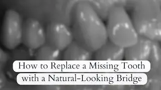 Dental Bridge for Natural Results