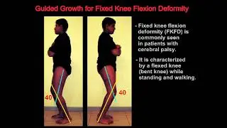 Guided Growth for Fixed Knee Flexion Deformity