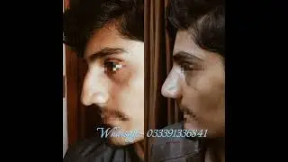 #rhinoplasty #nosejob #cosmeticsurgery #cosmetic #nosereshaping