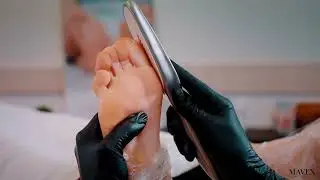 Mavex Calluspeeling MED - Video Demonstration