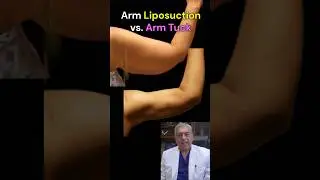 Arm Liposuction vs. Arm Tuck Brachioplasty #armliposuction #armworkout #armfat #flabbyarms #batwing