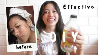 HOMEMADE FACE MIST (FOR ACNE PRONE AND OILY SKIN)
