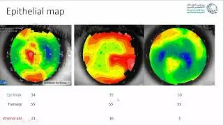 Excimer in Keratoconus: Pushing the limits or playing it safe?