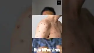 MPOX FACTS To Know! #health #mpox #disease