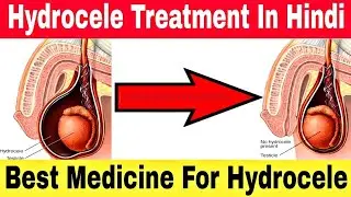 Hydrocele का इलाज कैसे करें | Hydrocele treatment without surgery | Hydrocele treatment tablets
