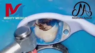 FURY ROTARY Files in mechanical preparation of MB2 Canal | single shaping file | root canal shaping