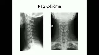 Cervikalni i lumbalini sindrom  Doc  P Ostojic   Cervikalni sindrom