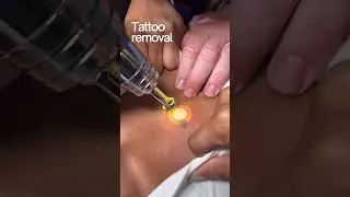 Letters Tattoo Removal at Alternative Laser Health | Precise Laser Treatment