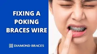 How to Fix a Long Wire Poking from Braces: Step-by-Step Demonstration