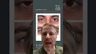 #ptosis #beforeandafter Dr. David Gay of Texas Eye Aesthetics