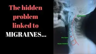 The hidden problem linked to migraines