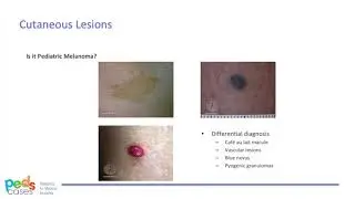 Approach to Pigmented Cutaneous and Ocular Lesions and Melanoma (PedsCases)