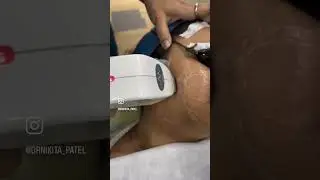 Laser Hair Removal in a patient with PCOS| Hair Removal laser clinic Thane  #painlesslaser