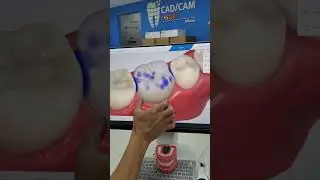 Fastest Omnicam on the Planet by CAD/CAM Center Miami® OmniBeast® Dentsply Sirona CEREC CAD/CAM