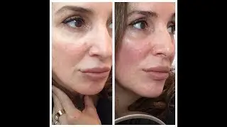 Facial Lifting & Toning with Microcurrent at home