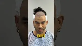 ✨ 4,799 Grafts with DHI Hair Transplant ✨