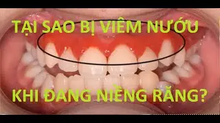 Đang niềng răng nhưng kh&ocirc;ng giữ VSRM th&igrave; sẽ như thế n&agrave;o?