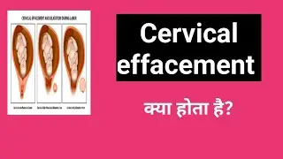 Cervical effacement/Medical term in hindi