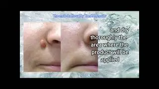 Mole Removal, Benign mole, Easy & Safe removal solution at home using 70% Glycolic Acid Peel