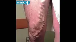Varicose Veins Spray