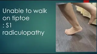 #4 Unable to walk on tiptoe: S1 radiculopathy