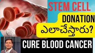 Stem Cell Donation Process: Stem Cell (Bone Marrow)Transplant For Blood Cancer | US Hematologist