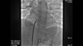 Device closure of perimembranous VSD without arteriovenous loop formation.