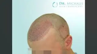 Hairforlife Kooperationsklinik Dr. Michalis 2800 Grafts - FUE Haartransplantation ohne Rasur