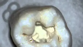 Labomed dental microscope magnification
