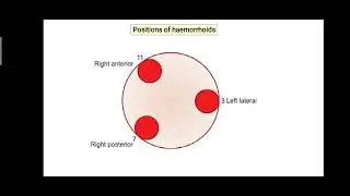 PILES (Hemorrhoids) + Rectal Bleeding