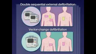 Defibrillationsstrategien bei refrakt&auml;rem Kammerflimmern