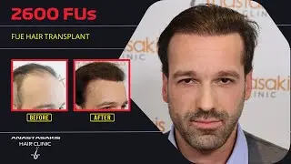 Από στάδιο 5 σε φυσικό hairline με 2600 τθ FUE! 🔥✨ | 12 μήνες μετά - case #419b