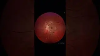 Let&rsquo;s dive into some drusen 🔎 #retina #oftalmo #ophthalmology #oftalmologia #oftalmolog&iacute;a #ophtalmo