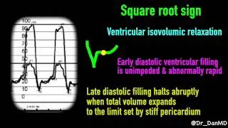 Constrictive pericarditis
