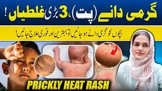 Prickly Heat Rash Treatment & Home Remedies | Dr. Zobaria Saleem